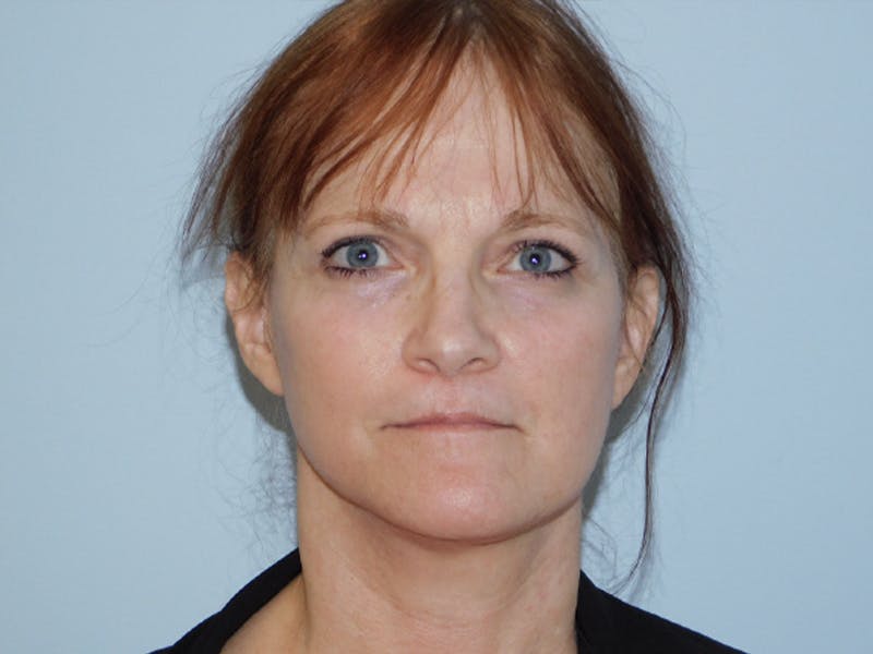 Facelift Before & After Gallery - Patient 133066406 - Image 4