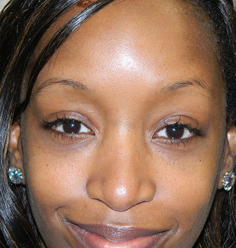 Blepharoplasty (Eyelid Lift) Before & After Gallery - Patient 133066403 - Image 2