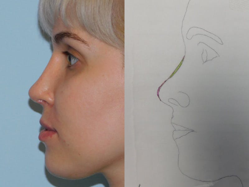 Revision Rhinoplasty Before & After Gallery - Patient 133066412 - Image 2