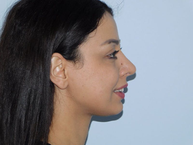 Neck (Submental) Liposuction Before & After Gallery - Patient 133066407 - Image 4