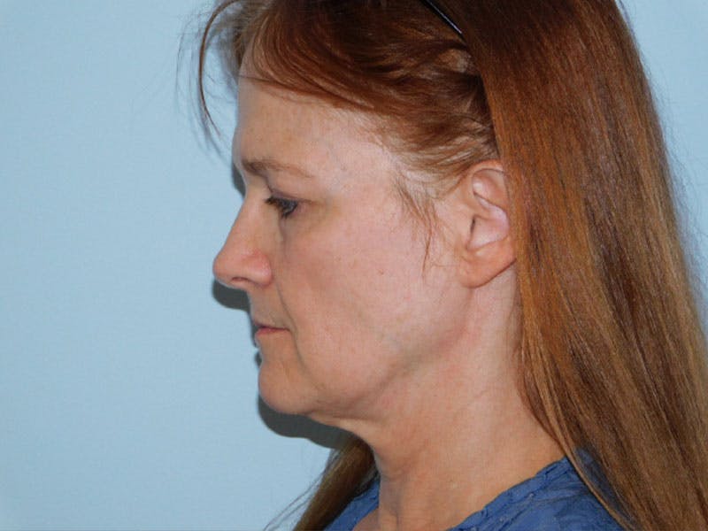 Facelift Before & After Gallery - Patient 133066406 - Image 5