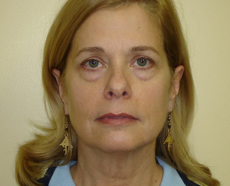 Blepharoplasty (Eyelid Lift) Before & After Gallery - Patient 133066409 - Image 1