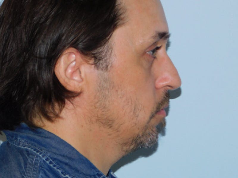 Rhinoplasty Before & After Gallery - Patient 133066419 - Image 1