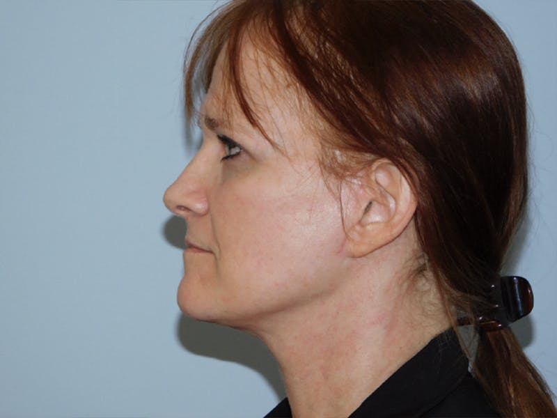 Facelift Before & After Gallery - Patient 133066406 - Image 6