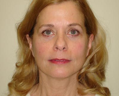 Blepharoplasty (Eyelid Lift) Before & After Gallery - Patient 133066409 - Image 2
