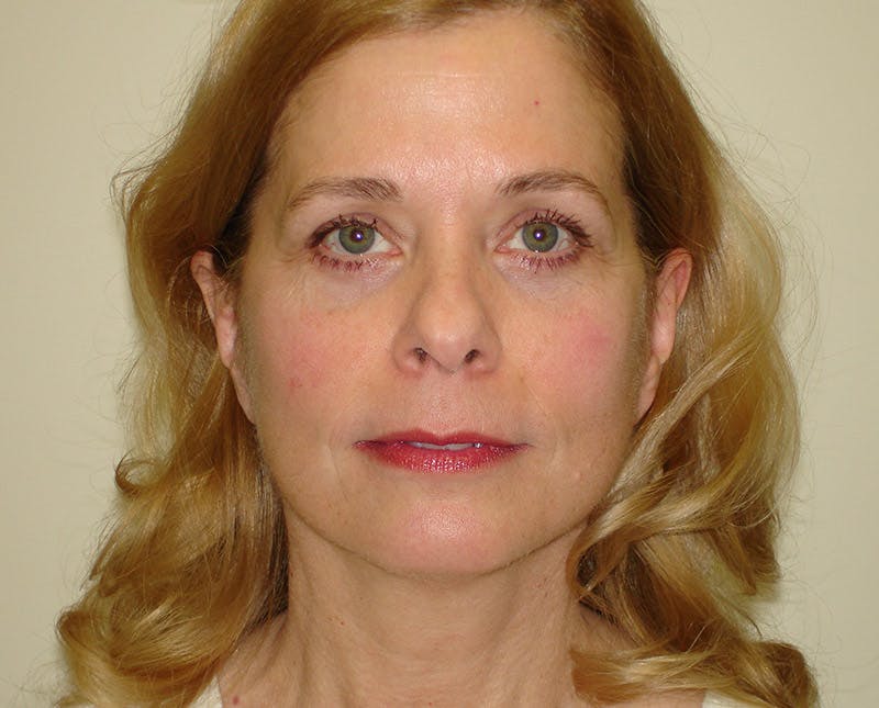 Blepharoplasty (Eyelid Lift) Before & After Gallery - Patient 133066409 - Image 2