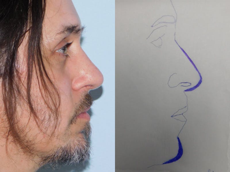 Rhinoplasty Before & After Gallery - Patient 133066419 - Image 2