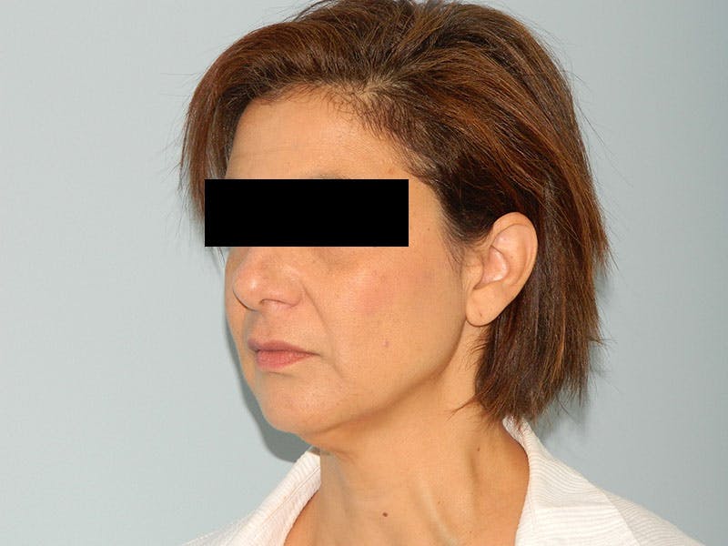 Mini-Facelift Before & After Gallery - Patient 133066410 - Image 1
