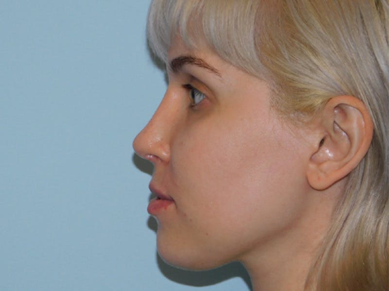 Revision Rhinoplasty Before & After Gallery - Patient 133066412 - Image 4