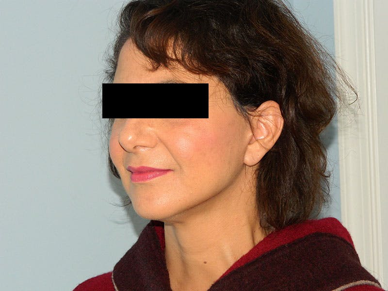 Mini-Facelift Before & After Gallery - Patient 133066410 - Image 2