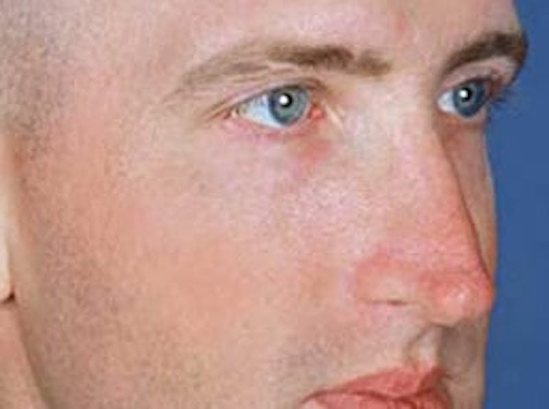 Cheek Augmentation Before & After Gallery - Patient 133066408 - Image 1