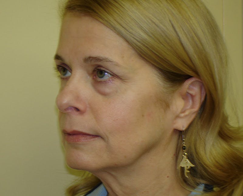 Blepharoplasty (Eyelid Lift) Before & After Gallery - Patient 133066409 - Image 3