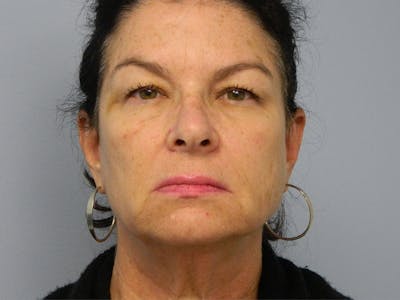 Facelift Before & After Gallery - Patient 133066411 - Image 1