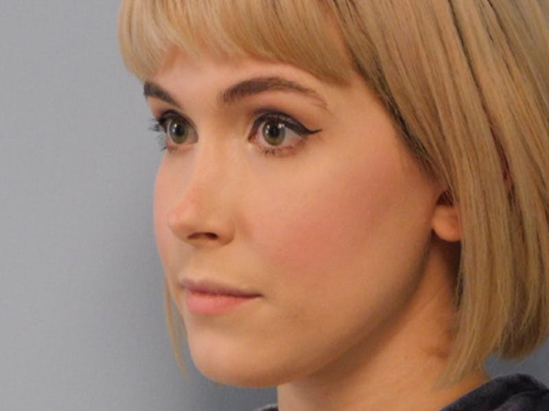 Revision Rhinoplasty Before & After Gallery - Patient 133066412 - Image 5