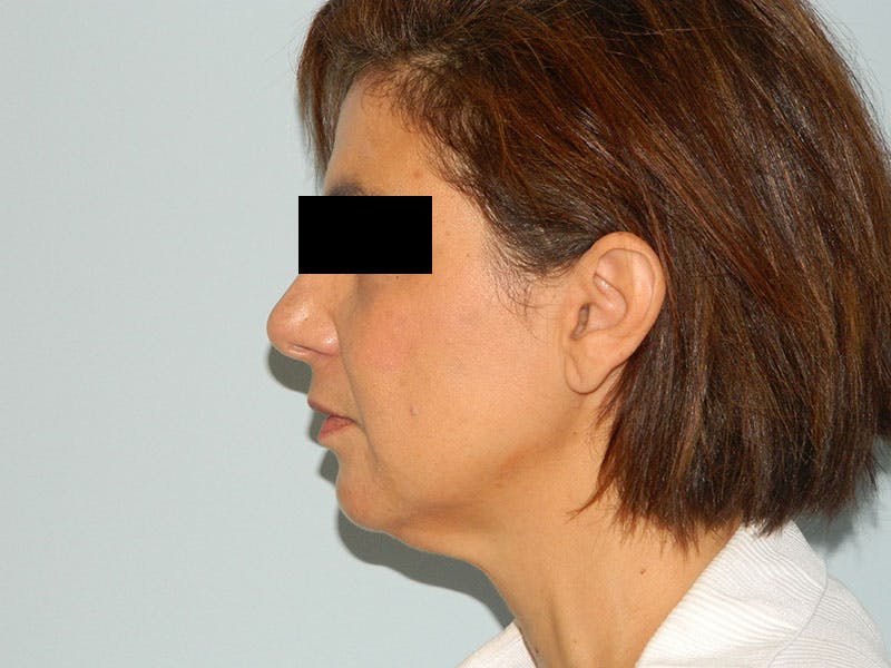 Mini-Facelift Before & After Gallery - Patient 133066410 - Image 3