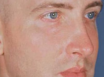 Cheek Augmentation Before & After Gallery - Patient 133066408 - Image 2