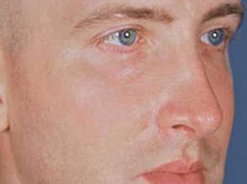 Cheek Augmentation Before & After Gallery - Patient 133066408 - Image 2