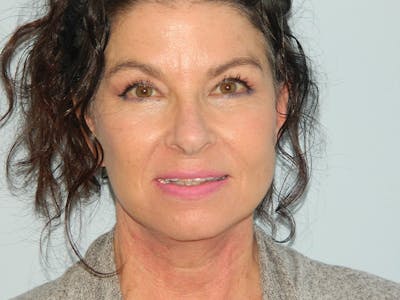 Facelift Before & After Gallery - Patient 133066411 - Image 2