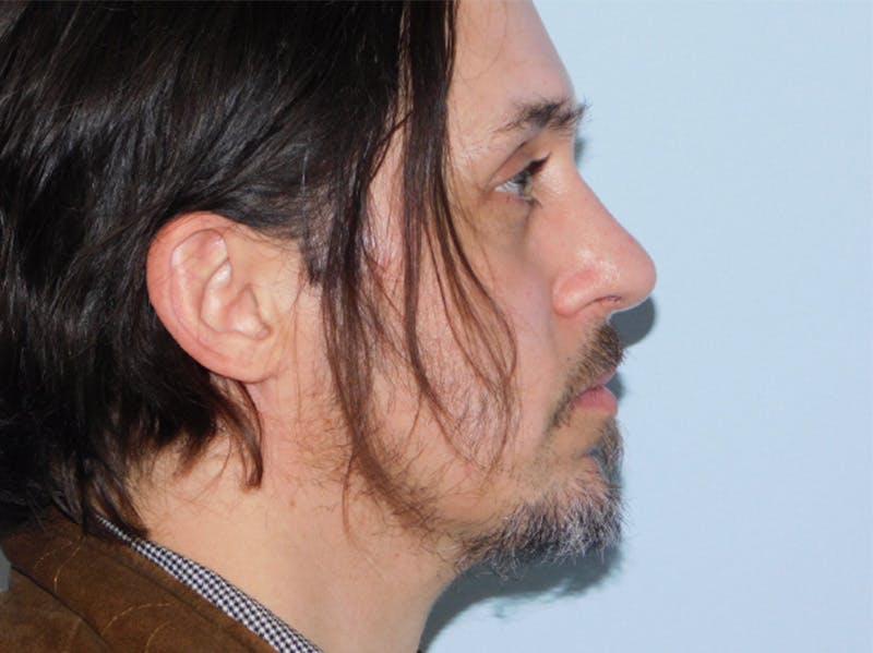Rhinoplasty Before & After Gallery - Patient 133066419 - Image 4
