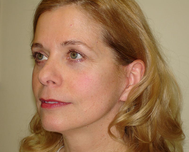 Blepharoplasty (Eyelid Lift) Before & After Gallery - Patient 133066409 - Image 4