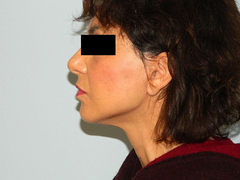 Mini-Facelift Before & After Gallery - Patient 133066410 - Image 4