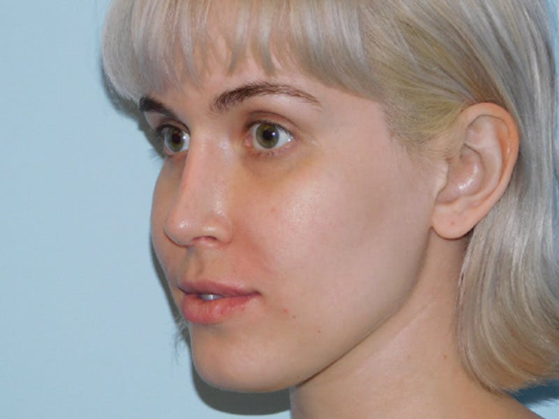 Revision Rhinoplasty Before & After Gallery - Patient 133066412 - Image 6