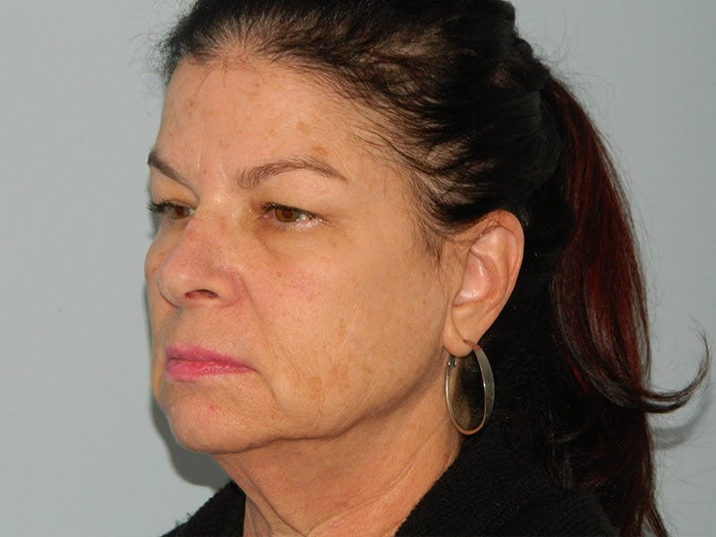 Facelift Before & After Gallery - Patient 133066411 - Image 3
