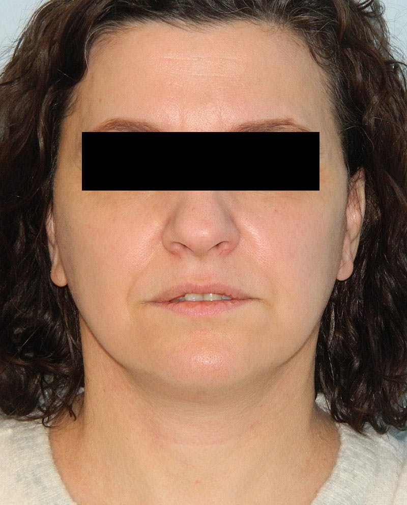 Neck (Submental) Liposuction Before & After Gallery - Patient 133066414 - Image 2
