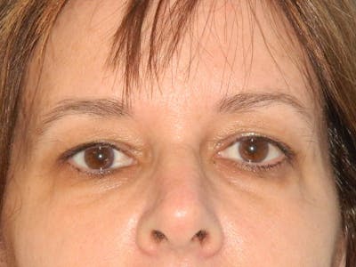 Blepharoplasty (Eyelid Lift) Before & After Gallery - Patient 133066420 - Image 1