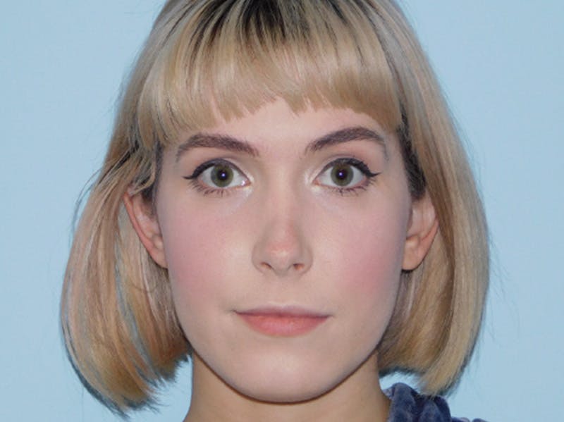 Revision Rhinoplasty Before & After Gallery - Patient 133066412 - Image 7
