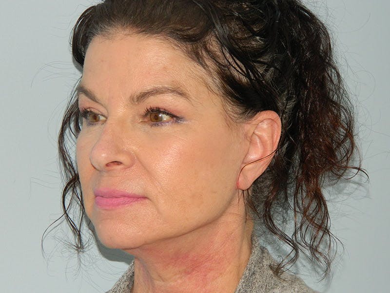 Facelift Before & After Gallery - Patient 133066411 - Image 4