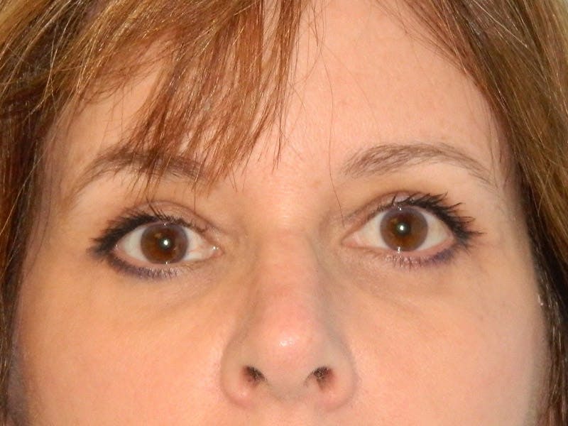 Blepharoplasty (Eyelid Lift) Before & After Gallery - Patient 133066420 - Image 2