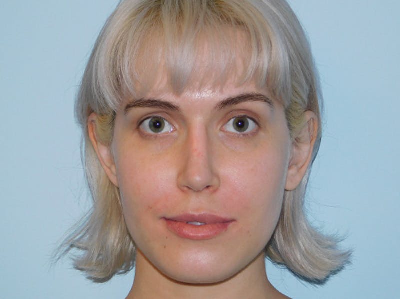 Revision Rhinoplasty Before & After Gallery - Patient 133066412 - Image 8