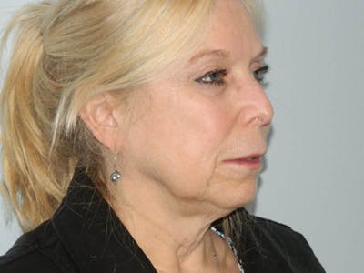 Facelift Before & After Gallery - Patient 133066417 - Image 1