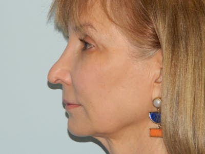 Revision Rhinoplasty Before & After Gallery - Patient 133066426 - Image 1