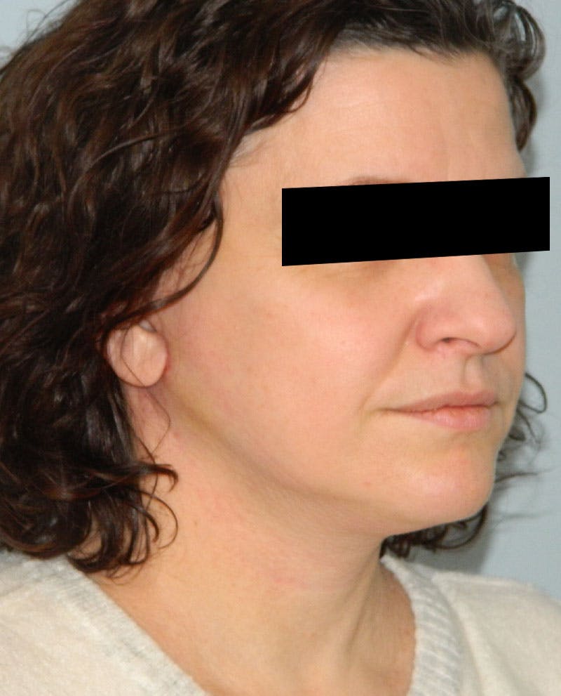Neck (Submental) Liposuction Before & After Gallery - Patient 133066414 - Image 4