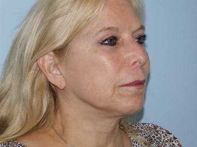 Facelift Before & After Gallery - Patient 133066417 - Image 2