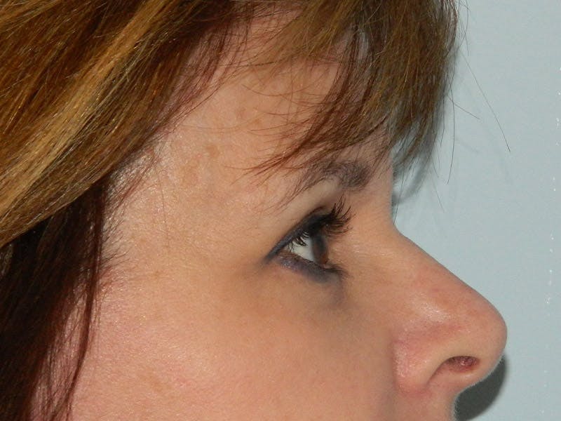 Blepharoplasty (Eyelid Lift) Before & After Gallery - Patient 133066420 - Image 4