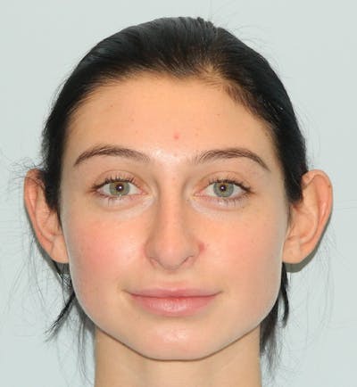 Otoplasty Before & After Gallery - Patient 133066416 - Image 1