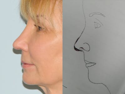 Revision Rhinoplasty Before & After Gallery - Patient 133066426 - Image 2