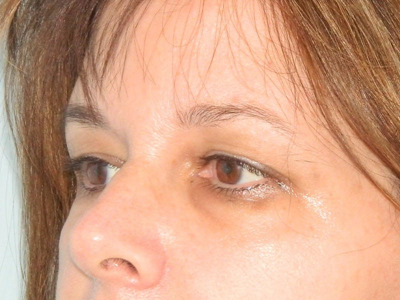 Blepharoplasty (Eyelid Lift) Before & After Gallery - Patient 133066420 - Image 5