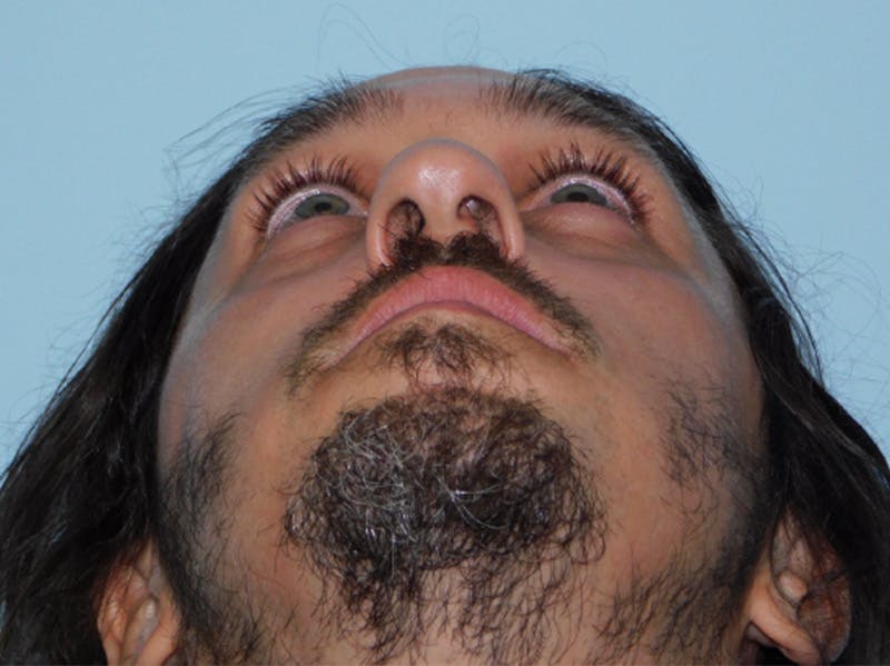 Rhinoplasty Before & After Gallery - Patient 133066419 - Image 9