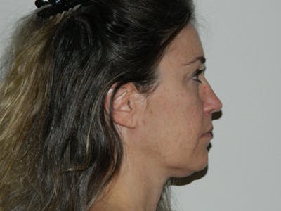 Neck (Submental) Liposuction Before & After Gallery - Patient 133066425 - Image 1