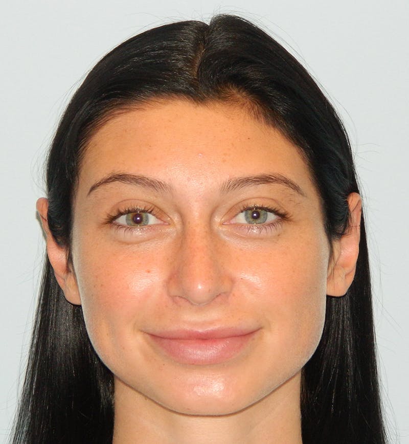 Otoplasty Before & After Gallery - Patient 133066416 - Image 2