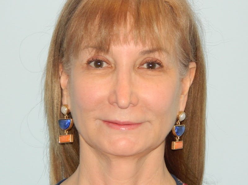 Revision Rhinoplasty Before & After Gallery - Patient 133066426 - Image 3