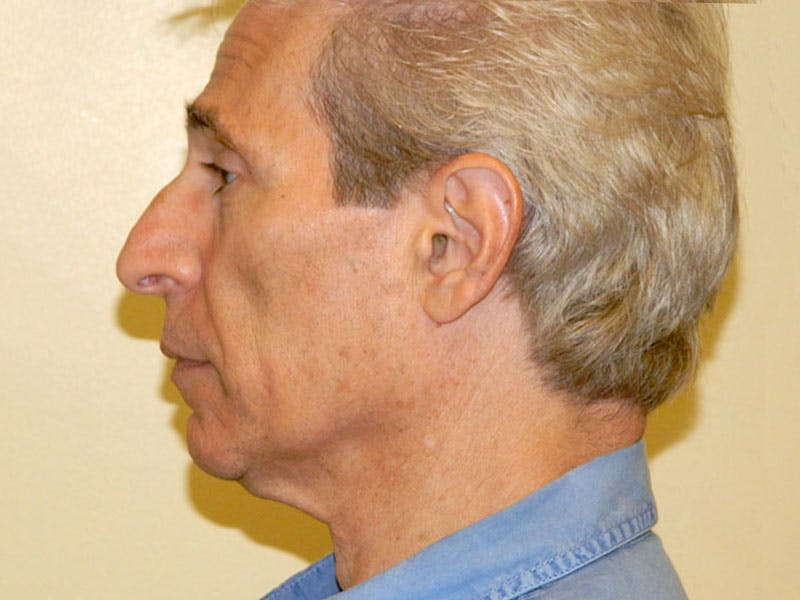 Mini-Facelift Before & After Gallery - Patient 133066418 - Image 5