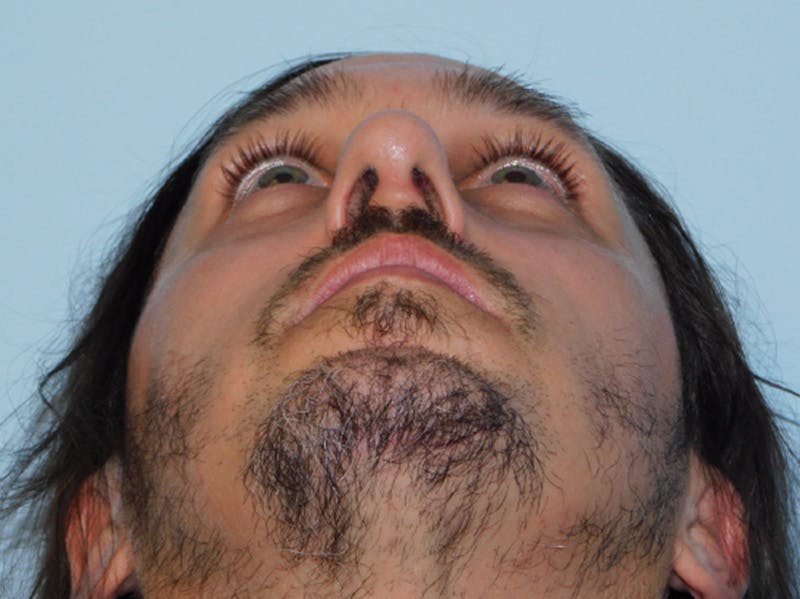 Rhinoplasty Before & After Gallery - Patient 133066419 - Image 10