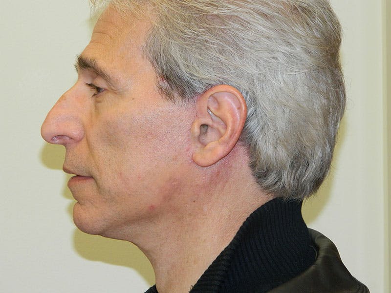 Mini-Facelift Before & After Gallery - Patient 133066418 - Image 6