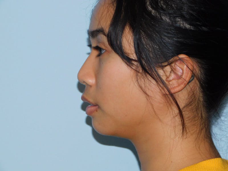 Chin Augmentation Before & After Gallery - Patient 133066427 - Image 1