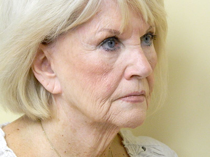 Facelift Before & After Gallery - Patient 133066430 - Image 1